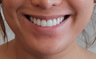 Lip Implant and Dimple Creation