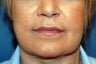 Corner of Lip Lift