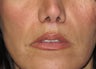 Lip lift - permanent lip enhancement