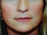 Sub Nasal Lip Lift
