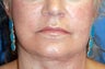 Corner of Lip Lift