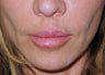 lip lift