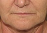 Lip lift