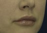 Lip Lift