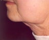 Lipodissolve and CoolSculpting