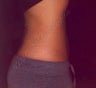 LipoDissolve injections to belly fat & love handles
