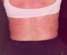 LipoDissolve injections to back fat