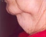 Lipodissolve and CoolSculpting
