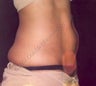 LipoDissolve injections to belly fat & love handles