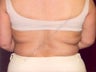 LipoDissolve injections to back fat