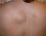 Back lipoma removal