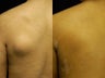 Lipoma Removal with Smartlipo Triplex