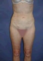 Liposculpture, Liposuction Surgery
