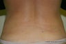 Body Jet Liposculpture