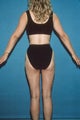 Liposculpture