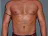 Liposculpting of the abdomen