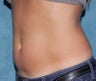 Stomach Liposculpture