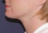 Neck lipo