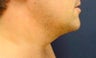 Male Neck Lipo 