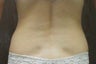 Lipo for Back and Love Handles