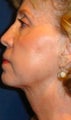 Neck liposculpture