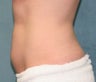 Stomach lipo