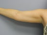 Smart Lipo