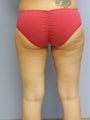 Liposculpture