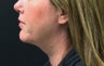 Laser-Assisted Lipocontouring of the Neck