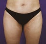 Liposuction of Abdomen, Inner Thighs and Outer Thighs