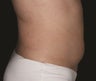 LipoSculpting of Upper and Lower Abdomen and Love Handles