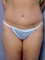 Tummy Tuck
