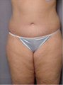 Adominoplasty
