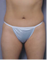 Abdominoplasty