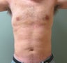 Liposculpture
