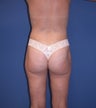 Before & After Liposculpture of the buttocks, thighs & hips