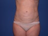 Abdominal Liposculpture