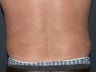 Body Liposculture
