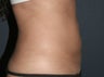 Liposculpture