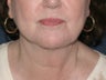 Liposculpture