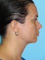 Neck Liposuction