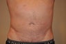 Liposuction of the abdomen and flanks (side/lower back)
