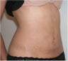 Liposculpture