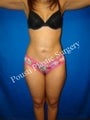 Liposuction