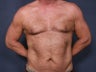 Liposuction