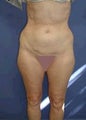 Liposculpture, Liposuction Surgery