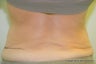 Body Jet Liposculpture