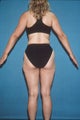 Liposculpture