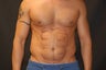 Liposculpting of the abdomen