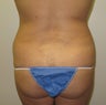 Liposculpture